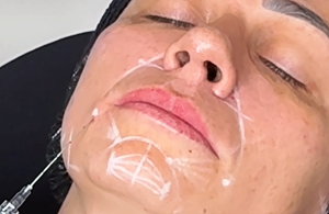 Aplicação de preenchimento facial feminino