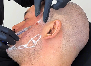 Aplicação de preenchimento facial masculino