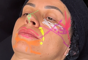 Marcação facial feminina para preenchimento