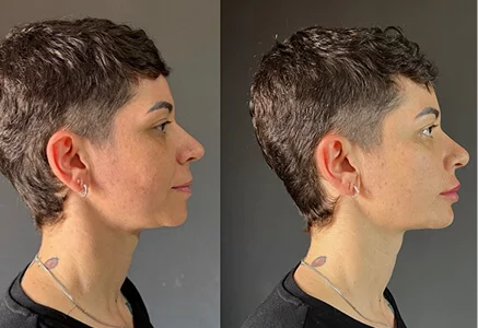 Resultado de tratamento 3