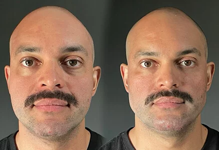Resultado de tratamento 2