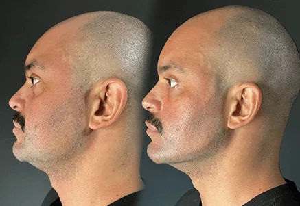 Resultado de tratamento 4